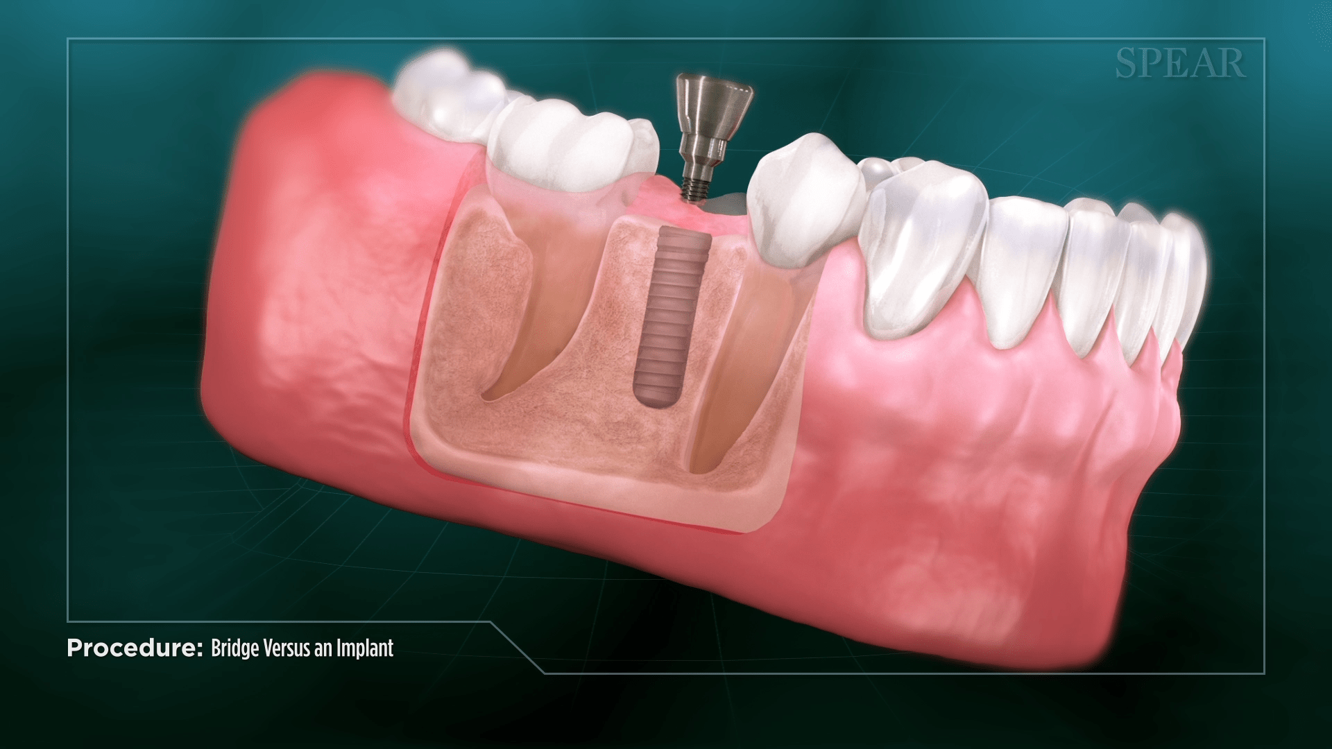Temporary Tooth Placement Procedure