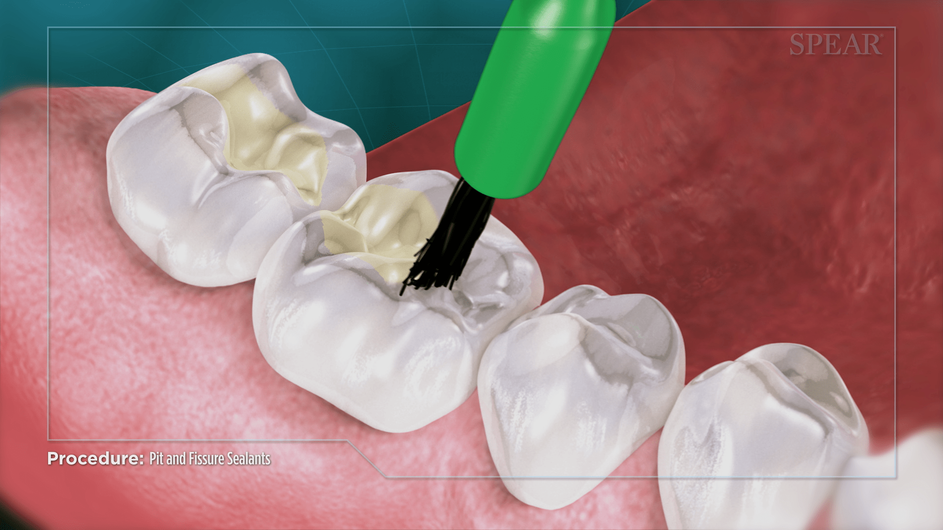 Sealant Application for Teeth Protection