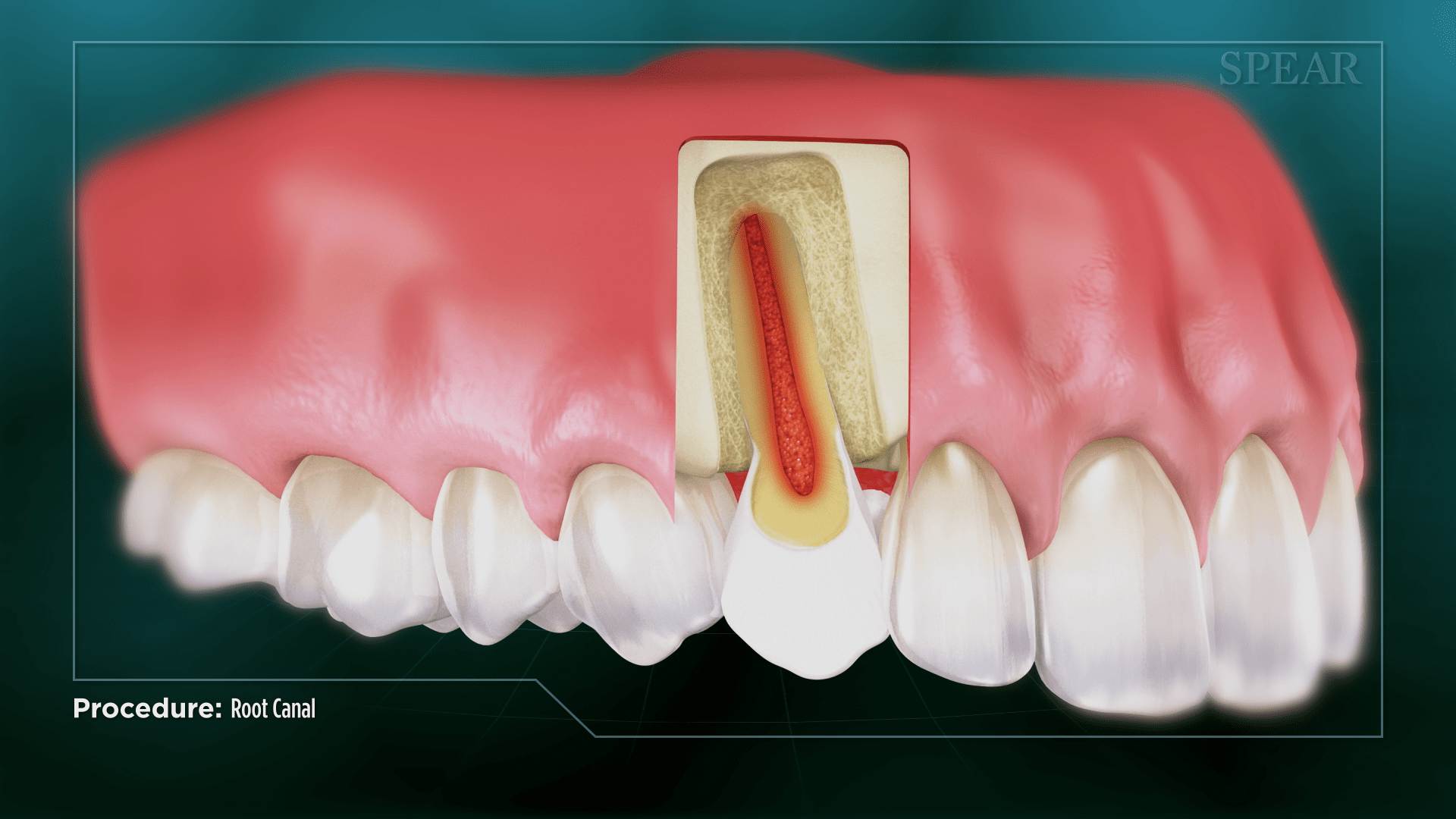 Damaged Nerve Treatment at Lifetime Dentistry