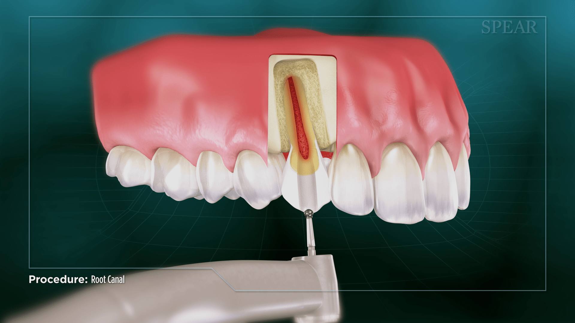 Interior Root Access and Treatment at Lifetime Dentistry
